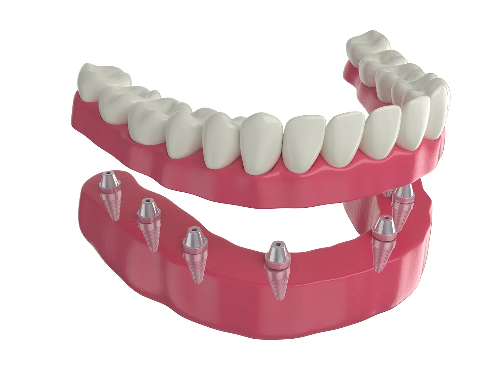 Dentures